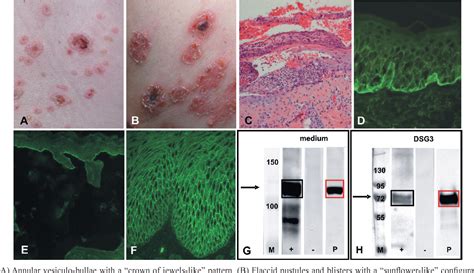Figure 1 From Overlap Of Iga Pemphigus And Linear Iga Dermatosis In A