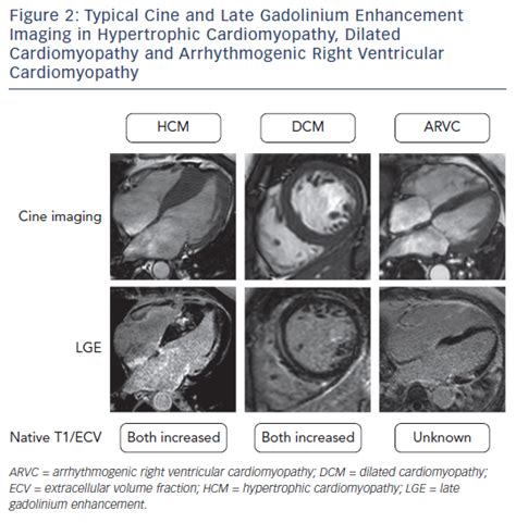 Figure 2 Typical Cine And Late Gadolinium Enhancement Imaging In