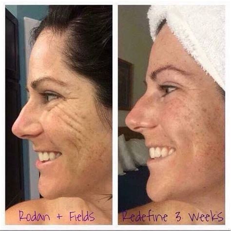Rodan And Fields Before And After Redefine All You Need Infos