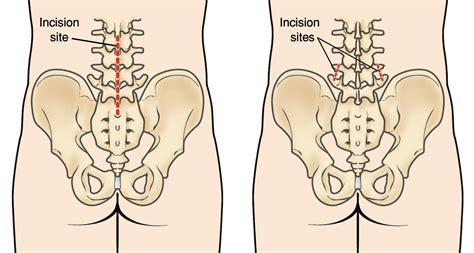 Minimally Invasive Vs Traditional Open Spine Surgery Explained The Spine Center