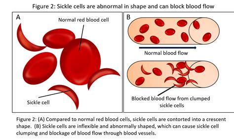 Sickle Cell Shape Image Diapharma