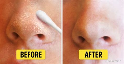 How To Remove Blackheads From Nose Top 5 Diy