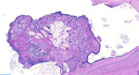 Pathology Outlines Teratoma Mature