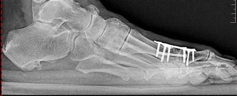 surgical correction of hallux limitus big toe joint arthritis central massachusetts podiatry