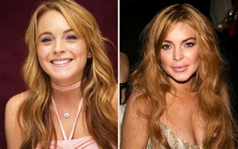 Lindsay Lohan Lip Augmentation Plastic Surgery Before And After Celebie