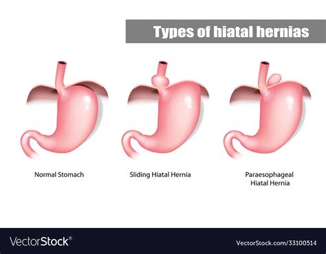 Types Hiatal Hernias Sliding And Paraesophageal Vector Image