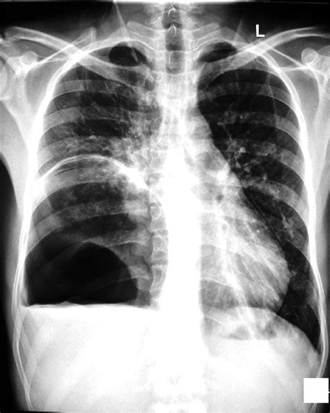 Chest Radiograph Postero Anterior View Showing Large Cystic Lesion
