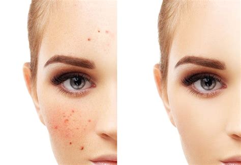 Treat Red Skin On Face 15 Causes And 8 Ways To Reduce It Skinkraft