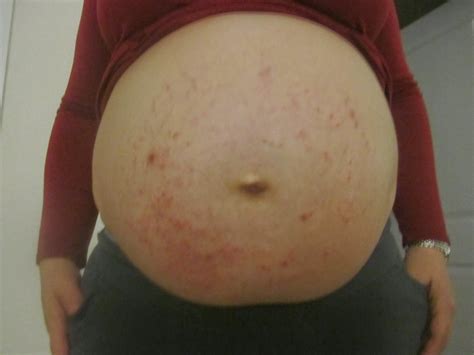 Rashes are like hives or welts. PUPPPs - the pregnancy rash you never wanted