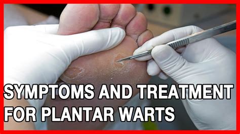 Symptoms And Treatment For Plantar Warts Youtube