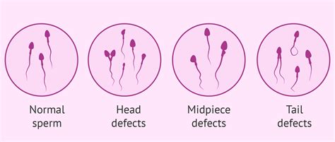 What Types Of Sperm Morphological Defects Exist