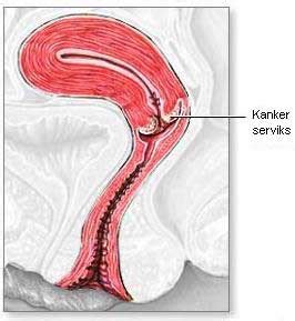 Kebiasaan buruk lainnya yang dapat menyebabkan kanker serviks adalah seringnya melakukan hubungan intim dengan berganti pasangan, melakukan hubungan intim dengan pria yang sering berganti pasangan dan melakukan hubungan intim pada usia dini (melakukan hubungan intim pada usia <16 tahun bahkan dapat meningkatkan resiko 2x terkena kanker serviks). GAKSI (Gerakan Anti Kanker Serviks Indonesia).: Info ...