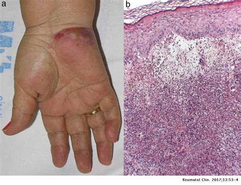 Neutrophilic Dermatosis Of The Hands Localized Sweets Syndrome