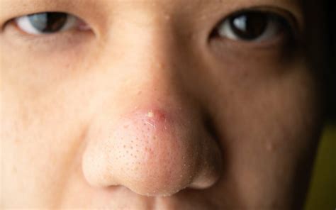 Whiteheads On Nose Understanding Causes Effective Treatments And
