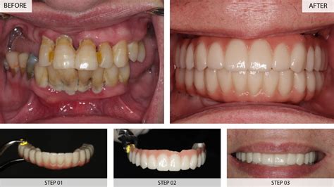 Dental Implants Results Before After Cases