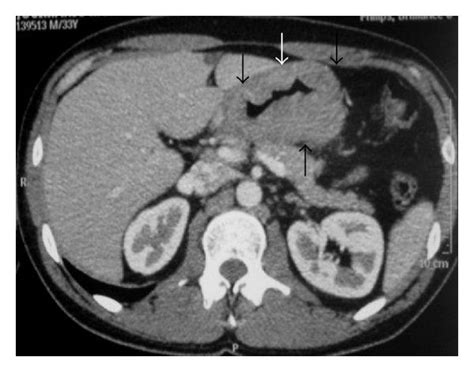 Patient With Peritoneal Lymphomatosis Axial Contrast Enhanced Ct Image