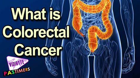 What Is Colorectal Cancer How Does Colorectal Cancer Start Cancer Tips Youtube