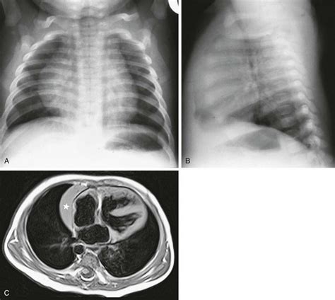 Chest Radiography In Pediatric Cardiovascular Disease Radiology Key