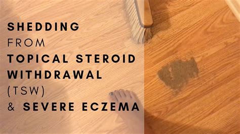 Healing Topical Steroid Withdrawal Tsw And Severe Eczema The Nat
