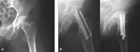 A B A Garden 1 Type Femoral Fracture In A 61 Years Old Male Patient