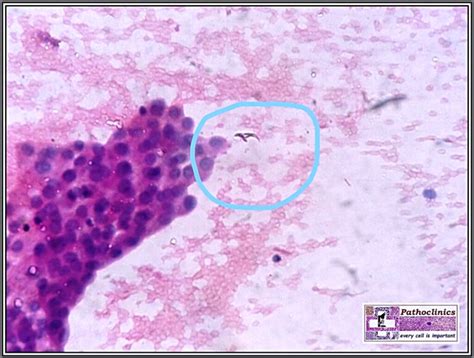 Cytology Of Hydatid Cyst Of Liver Surgical Pathology