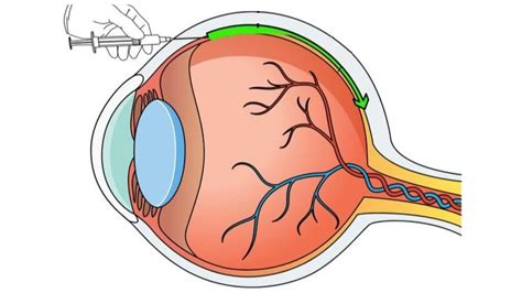Nanoparticles Enhance Gene Therapies For Eye Disease