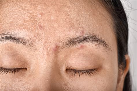 What Causes Premature Skin Aging And How You Can Avoid It