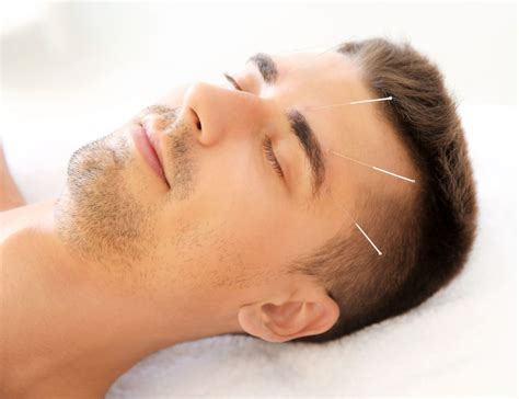Acupuncture Proven Effective For Migraine Relief