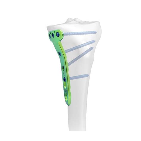 Proximal Medial Tibial T Locking Platetwin Holemedical Device