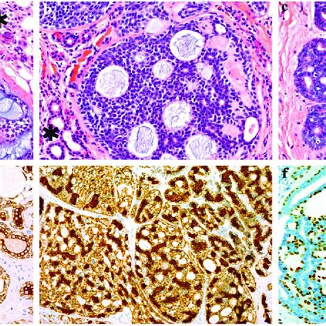 phenotypic profiling of adenoid cystic carcinoma of the salivary gland download scientific