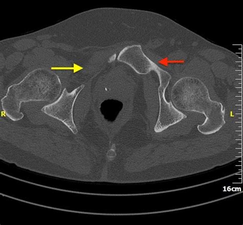 Cureus Pubic Bone Aplasia As An Incidental Finding In The Adult