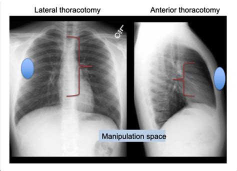Lateral Thoracotomy Provides More Manipulation Space Than