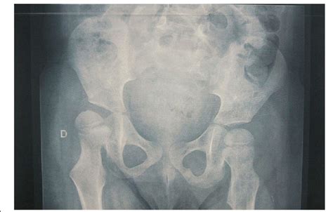Ap Pelvis Radiograph Demonstrating Classic Signs Of Neuromuscular Hip