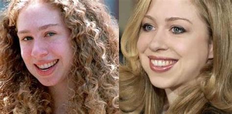 Plastic surgery procedures preformed on chelsea clinton Chelsea Clinton Plastic Surgery Before And After Pictures