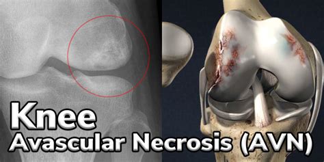 Knee Avascular Necrosis Dr Lox Sports And Regenerative Medicine