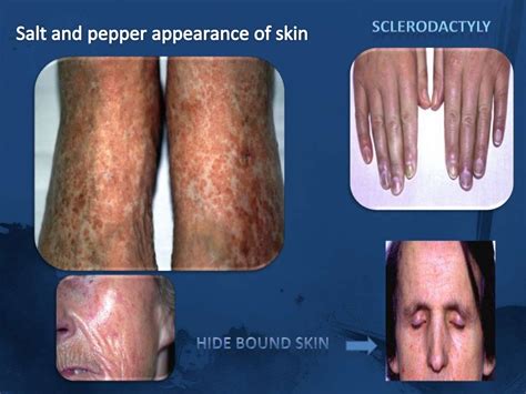 Systemic Sclerosisscleroderma