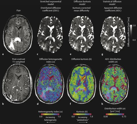 8 Diffusion Weighted Imaging For Gliomas Radiology Key