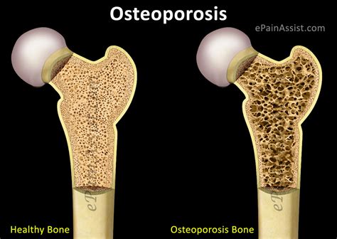 Osteoporosis Treatment Home Remedies Prevention Causes