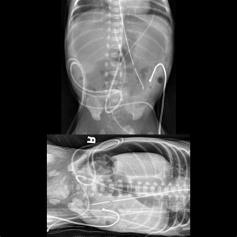 Pediatric Gastric Perforation Pediatric Radiology Reference Article Pediatric Imaging