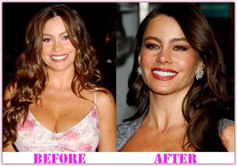 Sofia Vergara Plastic Surgery Face Before And After Photos