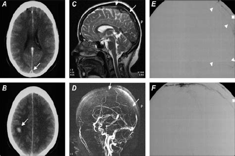 A Contrast Enhanced Ct Brain Showing An Empty Delta Sign Within The