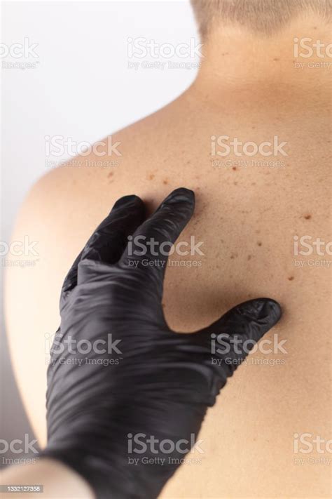 A Man At A Dermatologist Appointment Shows His Birthmarks Moles And