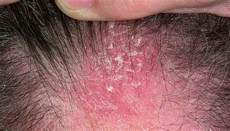 Seborrheic Dermatitis Summerlin Dermatolo­gy