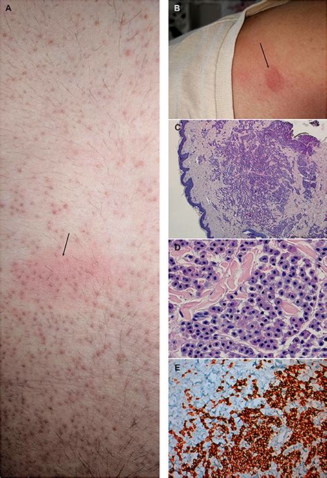 Frontiers Case Report Mastocytosis The Long Road To Diagnosis