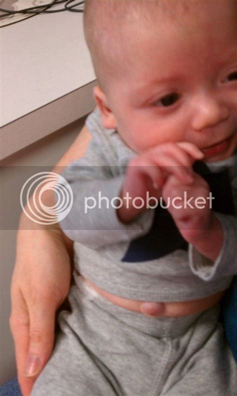 Herniated Belly Button Pics Babycenter