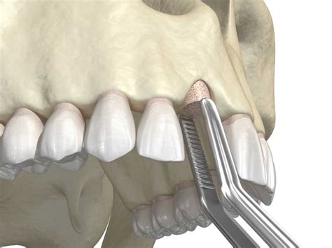 Bone Grafting For Facial Reconstruction Head And Neck Surgical