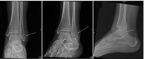 Lateral Malleolar Fracture Published In Orthopedic Reviews