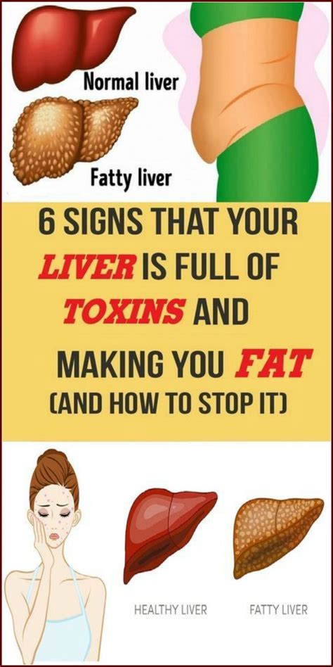 6 Signs That Your Liver Is Full Of Toxins Fatty Liver Healthy Liver