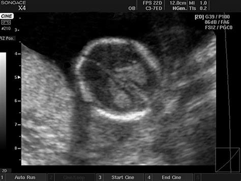 Ultrasound Images • Fetal Head B Mode Echogramm №412