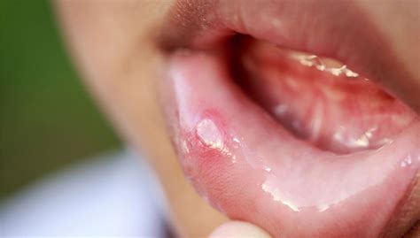Canker Sores Bioengineer Working On Bioadhesive Patch To Treat Ulcers